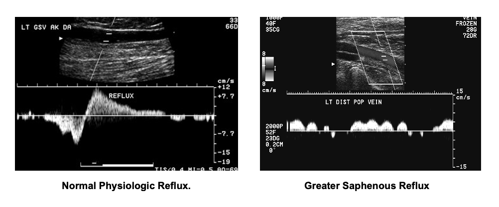 Venous Duplex Ultrasound is the Primary Imaging Modality for Reflux